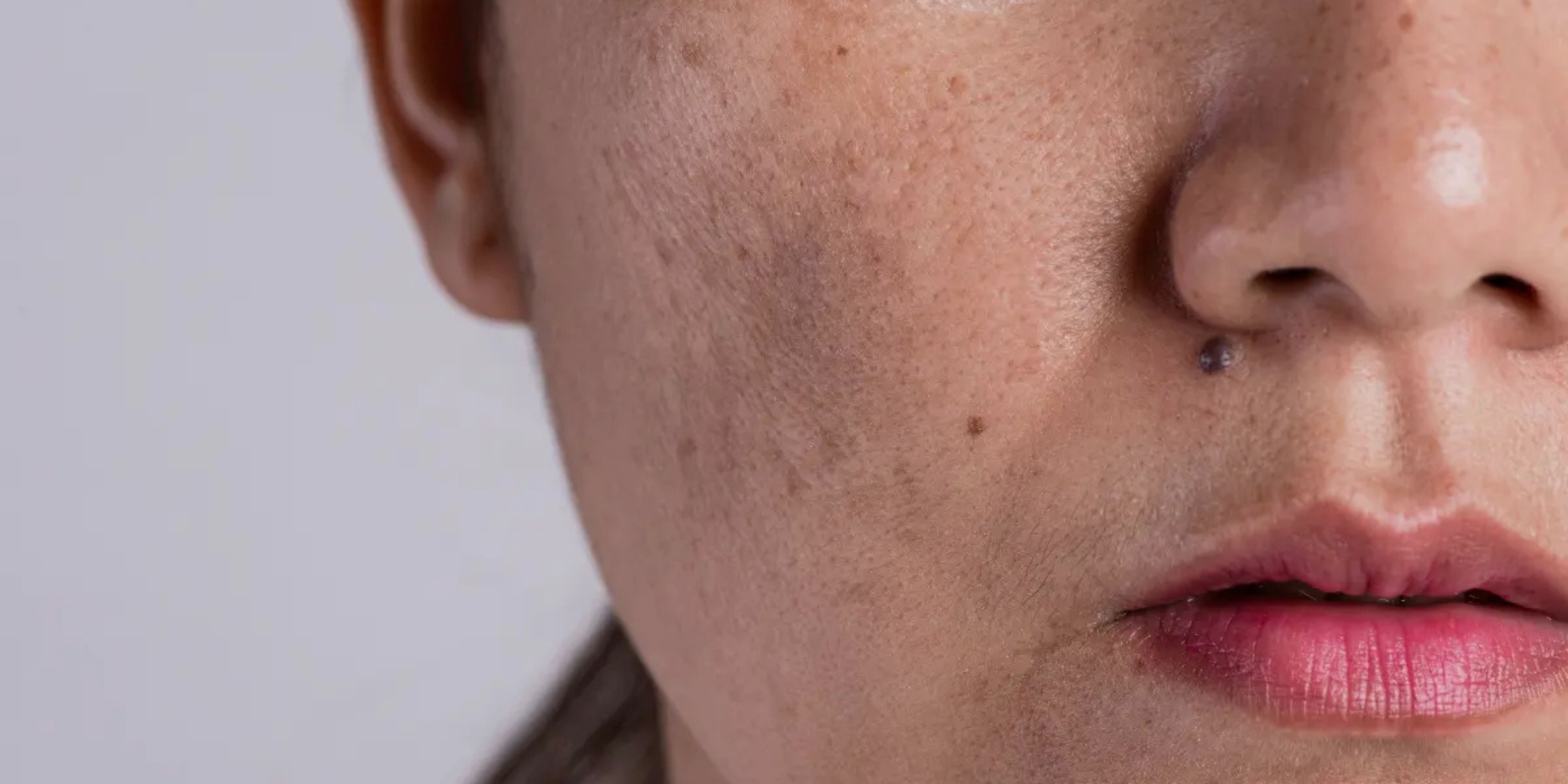 taches pigmentaires visage